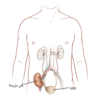 صورة أمامية لجسم ذكر تُظهر المسالك البولية والكلية المزروعة.