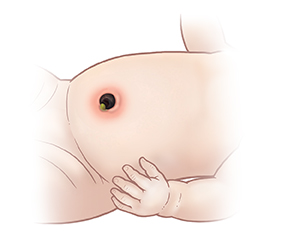 Detalhe do abdome de um bebê, mostrando uma inflamação na barriga ao redor do coto umbilical.